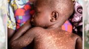 Measles outbreak kills 11 children in Napak