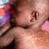 measles